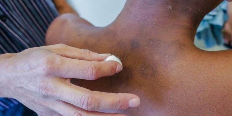 Pandemia de covid-19 faz notificações de hanseníase caírem 57% em 2021