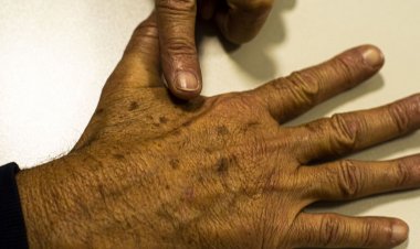 Ministério da Saúde abre consulta sobre diagnóstico do câncer de pele