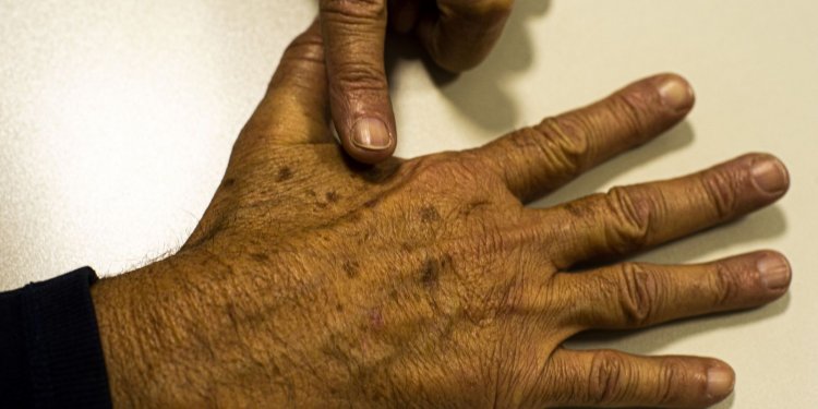 Ministério da Saúde abre consulta sobre diagnóstico do câncer de pele