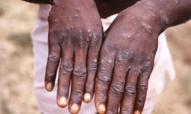 Brasil registra 978 casos de varíola dos macacos