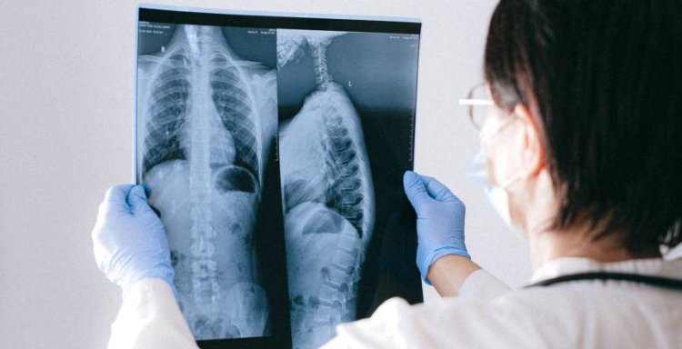 Tuberculose tem cura e tratamento garantido pelo SUS