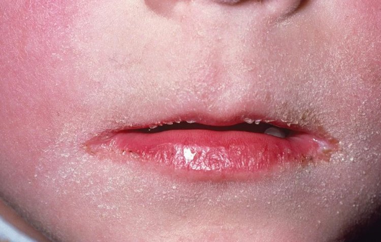 Caso de Bactéria Streptococcus Pyogenes em Ubá é desmentido