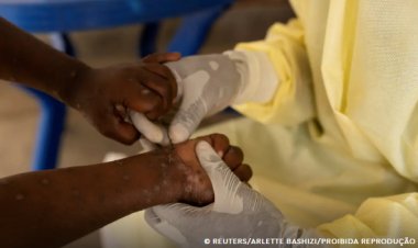 Saúde confirma primeiro caso de nova cepa de mpox no Brasil